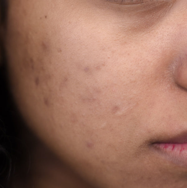 Dark Spots