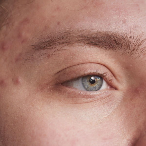 Acne