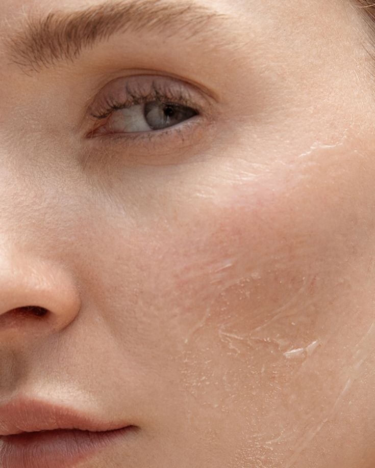 Dehydration & Dullness